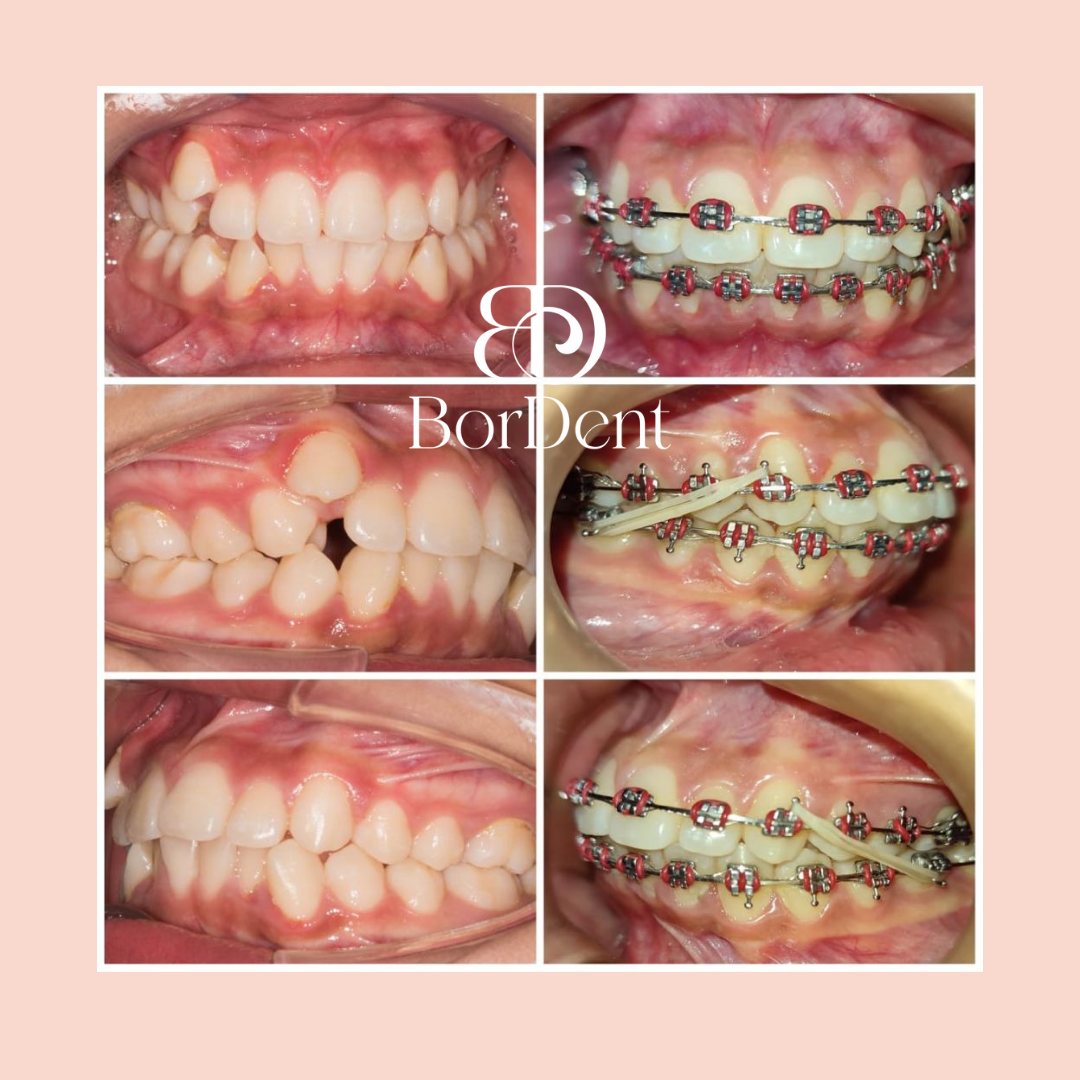 Caso de ortodoncia con brackets metálicos en BorDent Odontología: vistas frontal y laterales