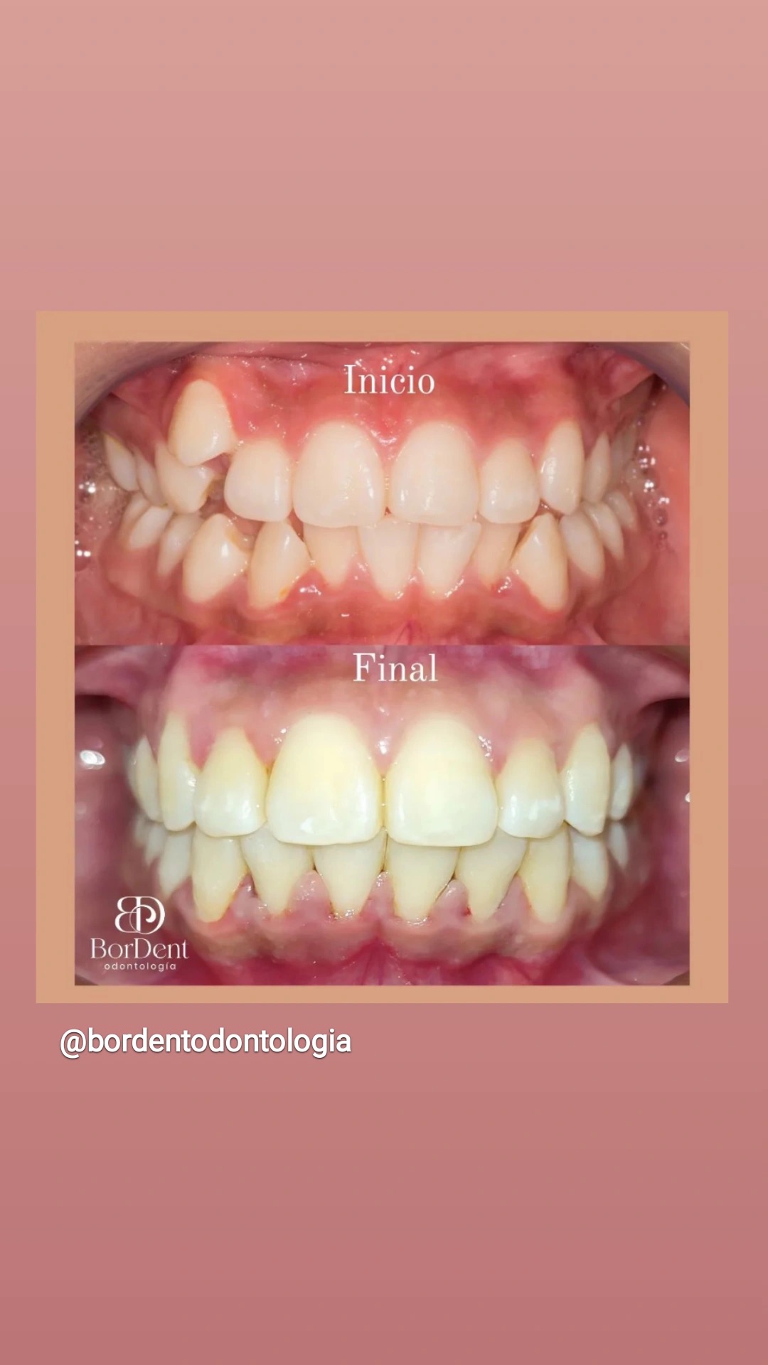 Caso real de ortodoncia en BorDent Odontología, Luque: antes y después del tratamiento